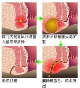 福州治肛瘘专业的医院